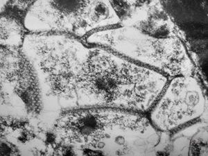 M,51y. | septate junctions between giant multivesicular bodies - lung, necrotizing pneumonia